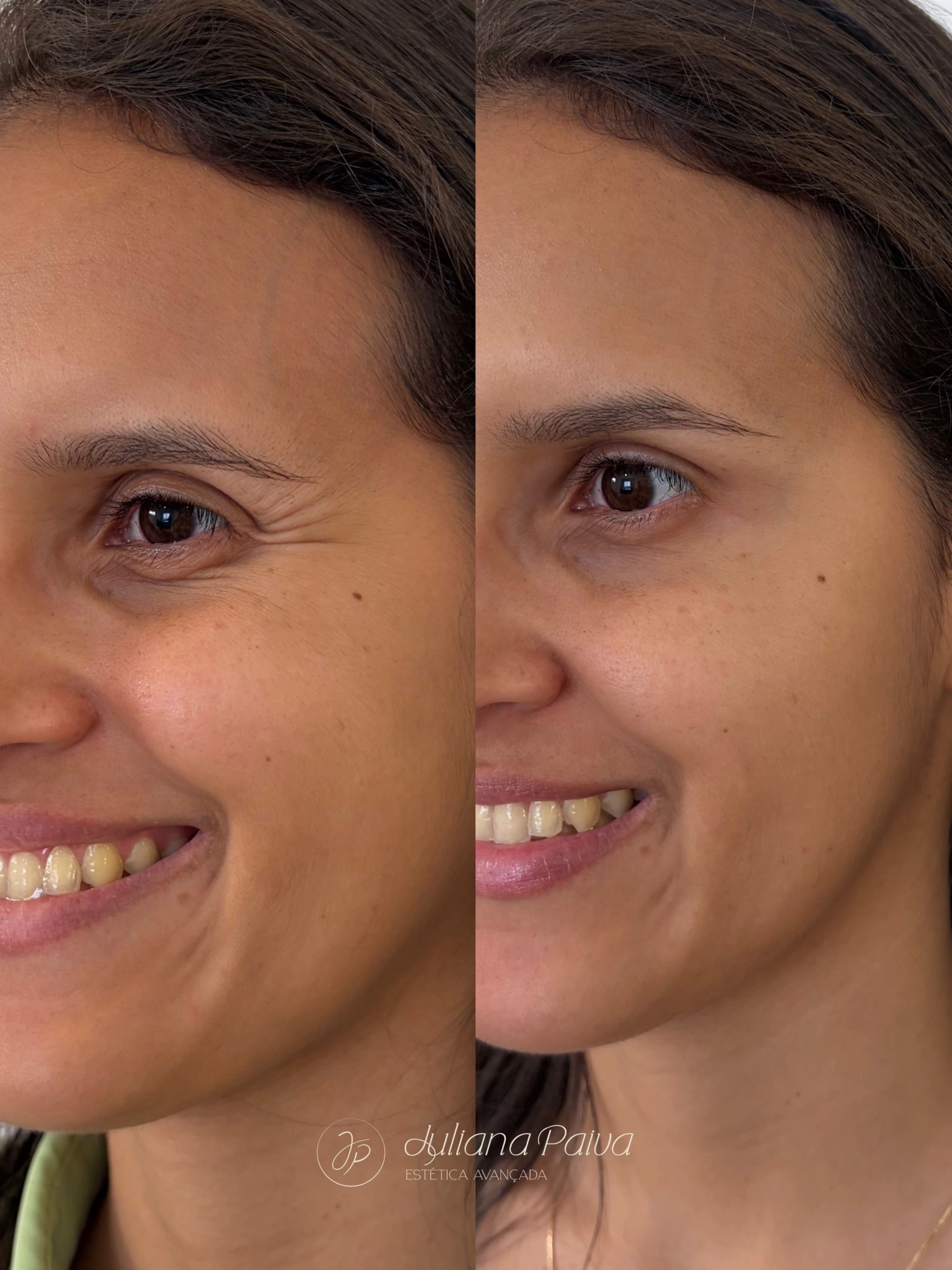 Comparação fotográfica da região dos olhos, apresentada lado a lado